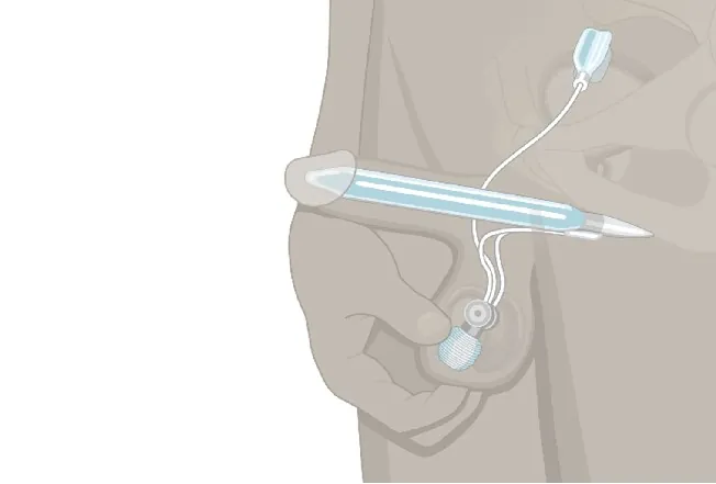 Two three-piece inflatable penile implants from different manufacturers